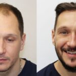 Trapianto di capelli